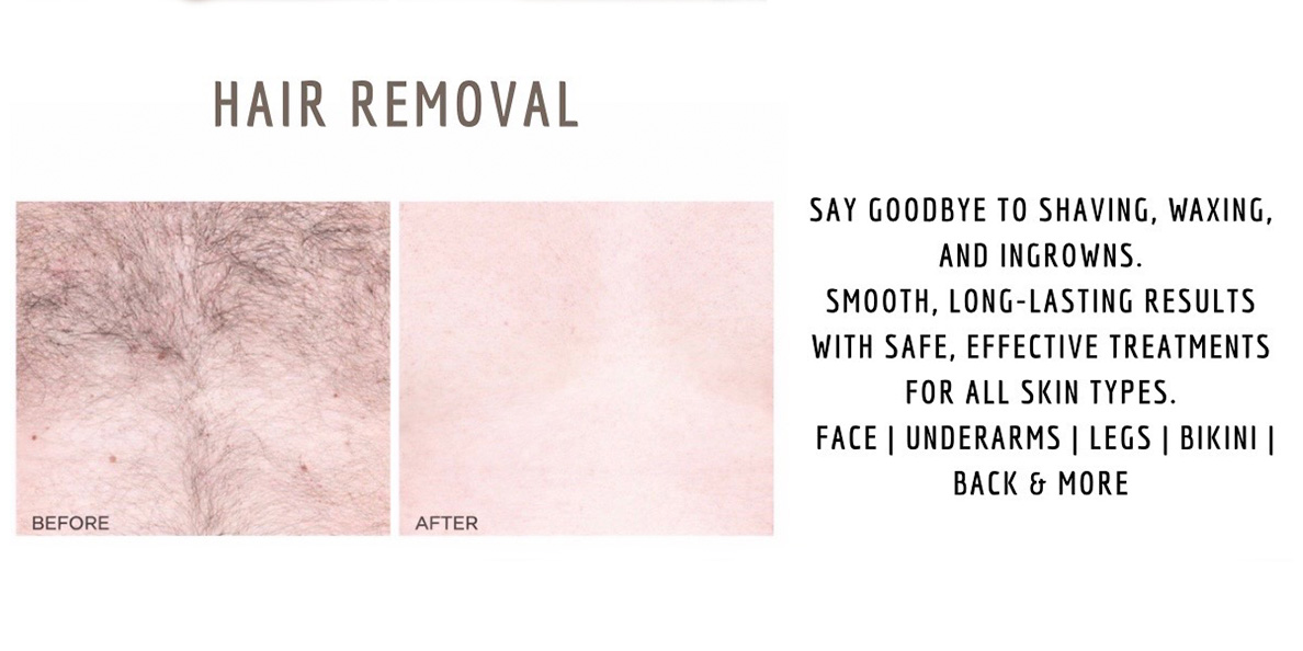 Laser Services Laser Services