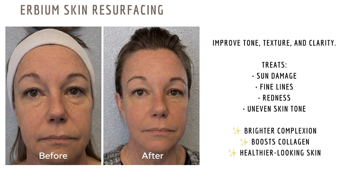 Laser - Skin Resurfacing