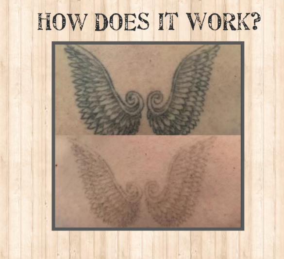 Laser - Tattoo Removal