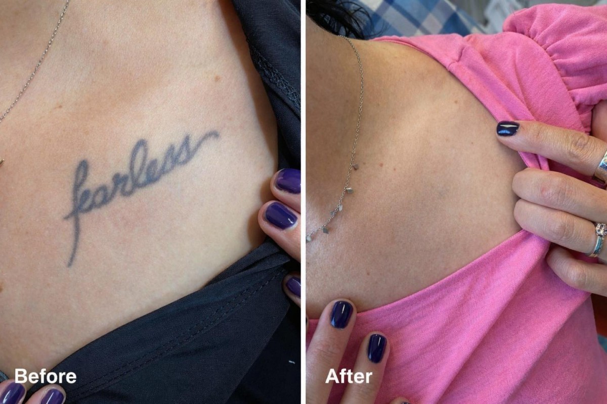 Laser - Tattoo Removal