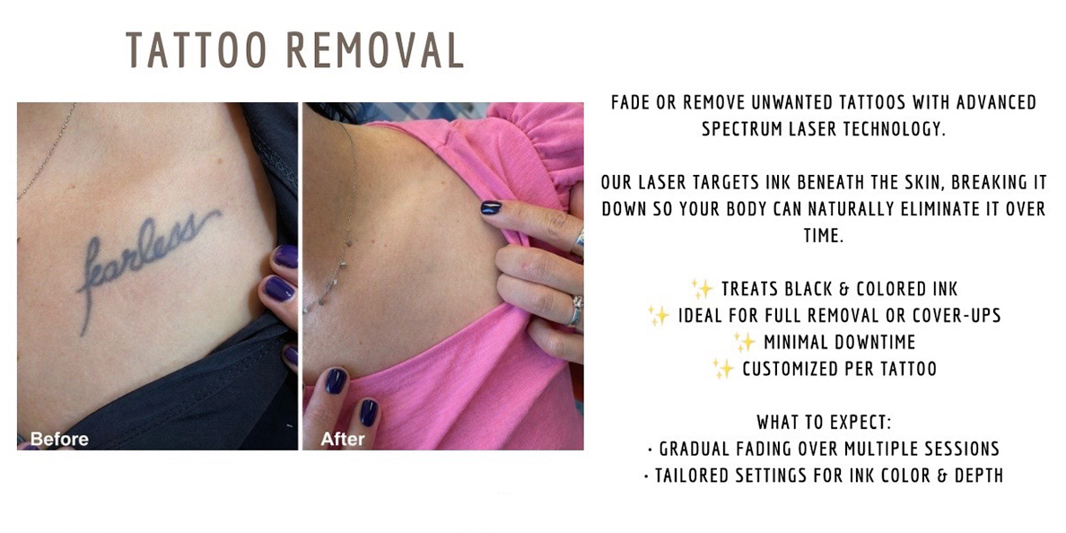 Laser - Tattoo Removal