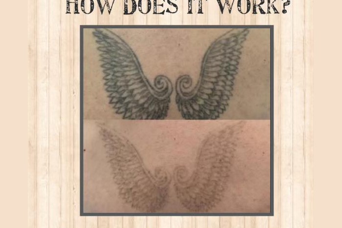 Laser - Tattoo Removal